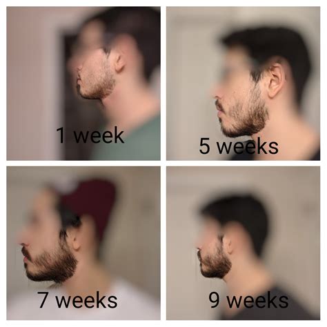 9 Weeks Into My Super Patchy Beard Journey Its Been A Tough One