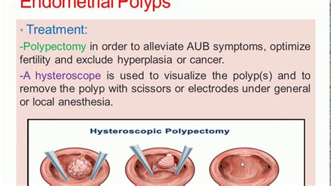 Benign Lesions Of The Uterus Youtube