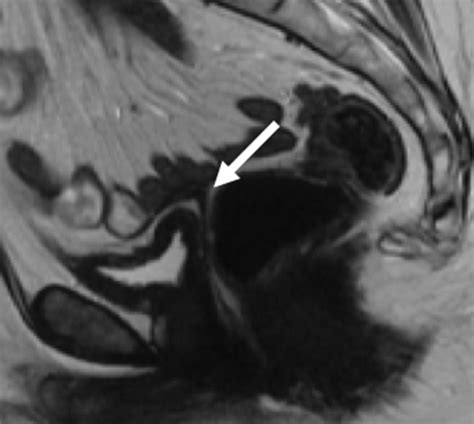 Congenital Anomalies Of The Upper Urinary Tract A Comprehensive Review Radiographics