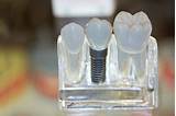 Dental Implant Payment Plans Pictures