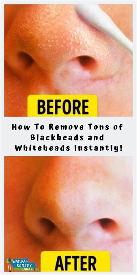 Home Remedies For Whiteheads Removal Food Blog