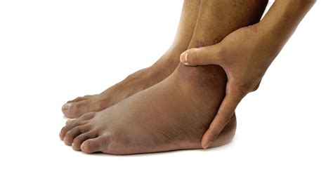 Managing Swollen Feet And Ankles Caused By Heart Failure