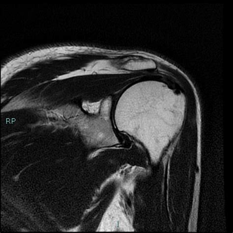 Supraspinatus Calcific Tendinitis With Intraosseous Migration Image