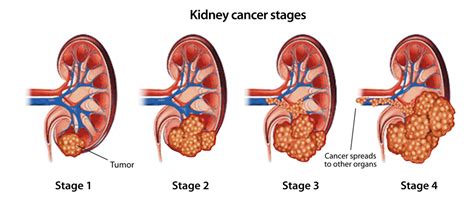 Kidney Cancer Renal Cancer Signs Symptoms Saint Johns Cancer