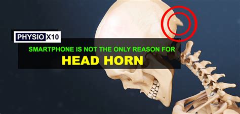 Smartphone Is Not The Only Reason For Horn Behind Your Head Physio X10
