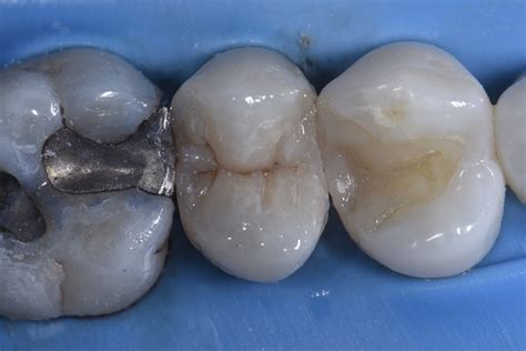 Large Old Fillings Selectively Removed And Restored