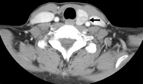 Preoperative Axial Ct Scan Shows Left Thyroid Lobe With Heterogeneous