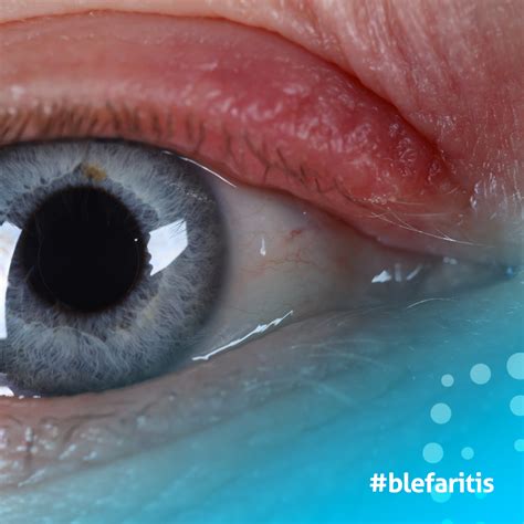 Blefaritis Qué Es Causas Y Tratamientos Clinicas Tecnovision