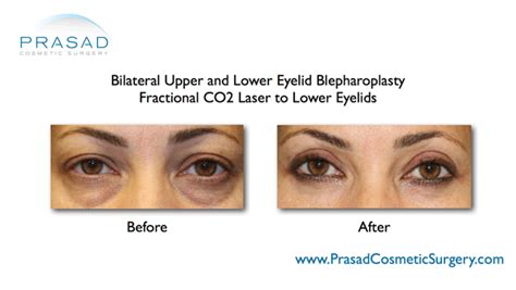 Regenerative Treatment For Under Eye Wrinkles With Eye Bag Surgery