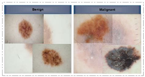 Diagnostics Free Full Text Precision In Dermatology Developing An