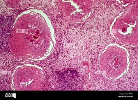 Schistosomiasis Urinary Bladder Stock Photo Alamy