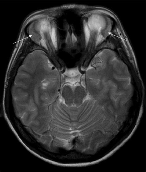 Mri Study Magnetic Resonance Imaging Glands Swollen