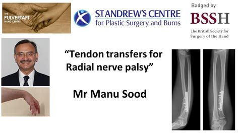 Tendon Transfers For Radial Nerve Palsy Youtube