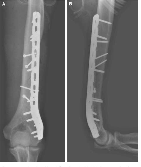 Figure From Surgical Fixation Of Extra Articular Distal Humerus Fractures With A