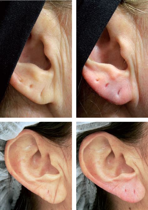 Chapter 15 Filler Injection Of The Preauricular Region And The Earlobe