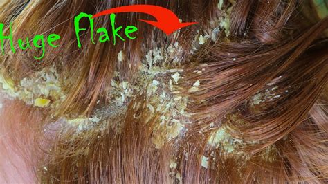 Huge Oily Psoriasis Flakes Scalp Scratching For Great Relax Big Flake