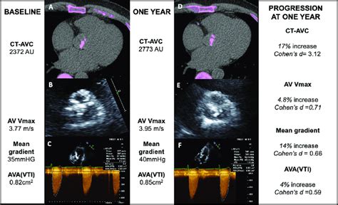Ct Calcium Scoring And Echocardiography To Monitor Disease Progression