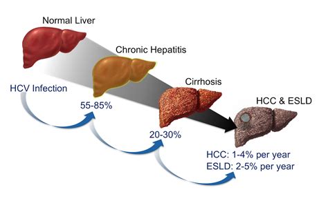 Natural History Of Hepatitis C Viral Hepatitis And Liver Disease