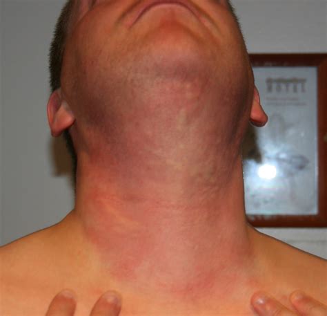 Hives On My Neck After Taking A Reaction To The Horses Flickr