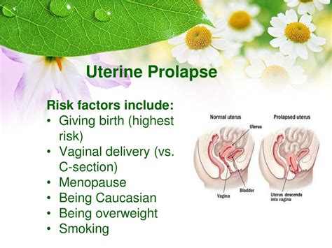 Ppt Best Uterus Prolapse Treatment Powerpoint Presentation Free