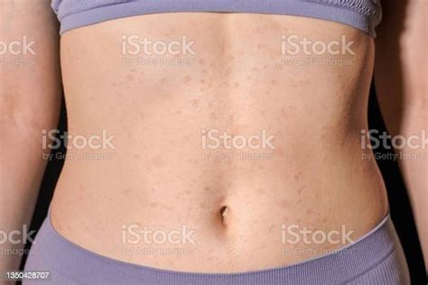 Red Allergic Rash On Stomach Skin Skin Allergy Atopic Dermatitis Eczema