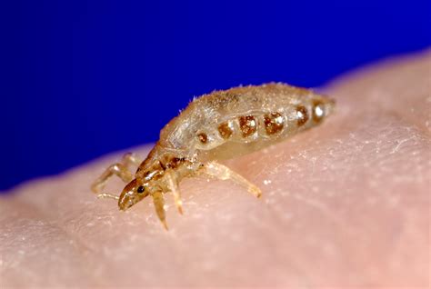 Body Lice Symptoms Diagnosis Treatment Pictures Home Remedies