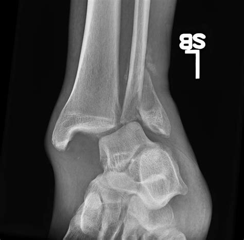 Unstable Weber B Ankle Fracture 6 Weeks Out In A Noncompliant Patient