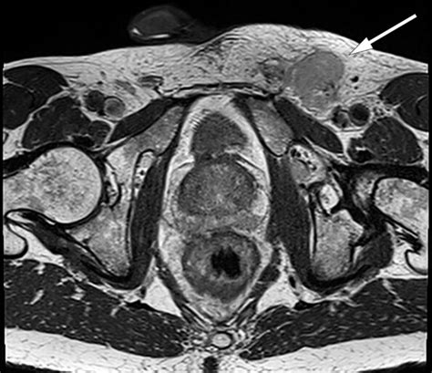 Swollen Lymph Nodes In Male Groin Area