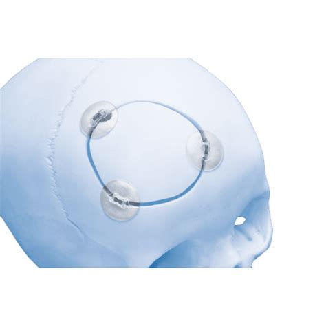Absorbable Cranial Fixation System Rapidsorb Depuy Synthes