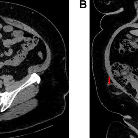 A Axial View Of Ct Abdomen And Pelvis Demonstrating Spigelian Hernia