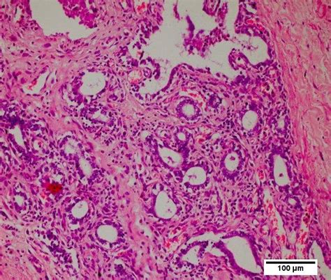 Photomicrograph Of Chronic Mastitis Showing Fibrous Connective Tissue