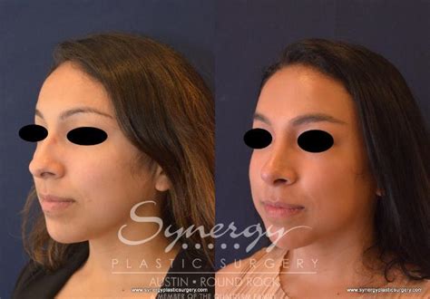 Rhinoplasty Before And After Photo Gallery Austin TX Synergy Plastic Surgery