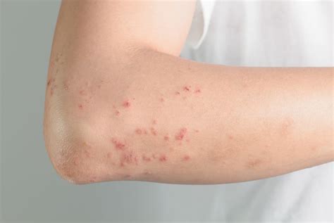 10 Possible Causes For Those Bumps On Your Skin Health And Detox And Vitamins