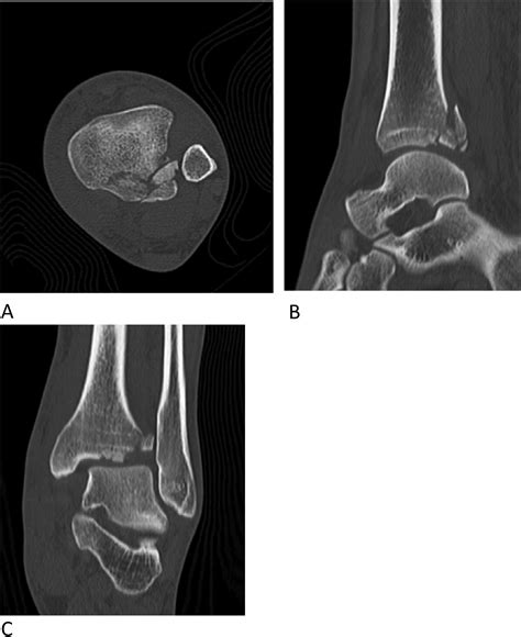 Direct Fixation Of Fractures Of The Posterior Pilon Via A Posteromedial