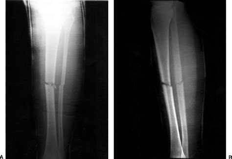 Tibial And Fibular Shafts Radiology Key