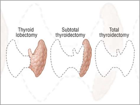Thyroidectomy Thyroid Cancer Treatment Thyroid Removal Surgery