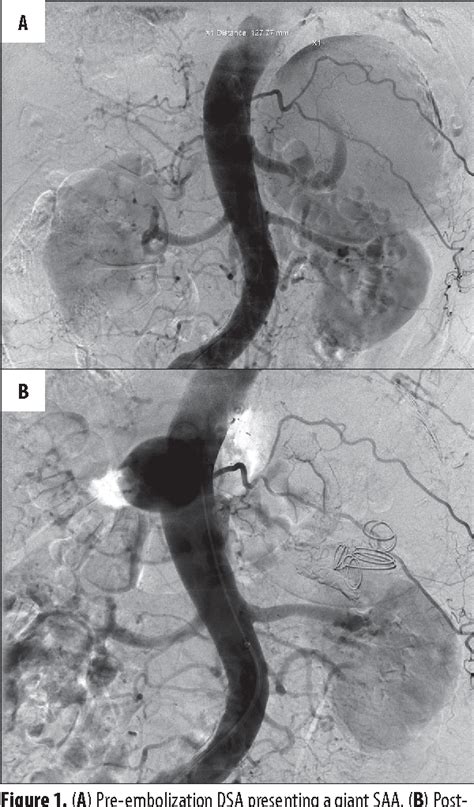 Figure 1 From Embolization Of A True Giant Splenic Artery Aneurysm