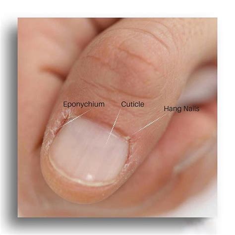 If This Looks Like Your Fingers You May Have A Nail Vitamin Deficiency