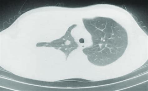 Chest Computed Tomography Scan Showing Pleural Effusion In The Right
