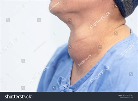 Enlarged Multinodular Thyroid Goiter Middleaged AsianẢnh Có