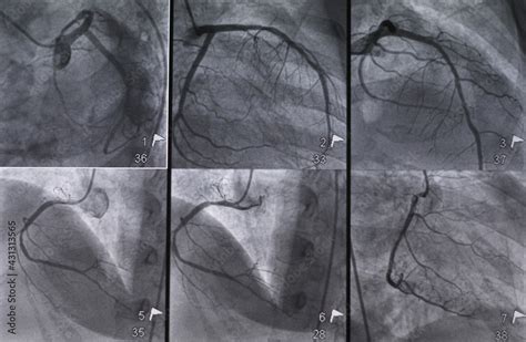 Coronary Angiogram Cag Was Performed Left And Right Coronary Artery