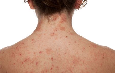 Dermatite Atopica Cause E Rimedi Naturali Verdebenessere