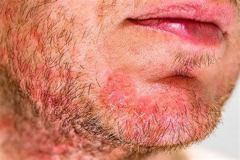 Demodex Mites The Microbiome And The Treatment Of Rosacea Border