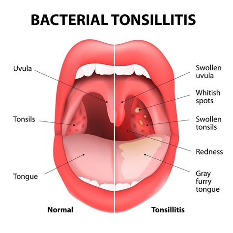 Gross Science Tonsil Stones Astral Projection