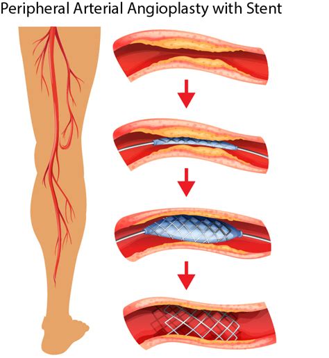 Angioplasty And Stent Placement