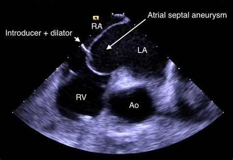 Ice Home View Showing Large Intra Atrial Septal Aneurysm Arrow