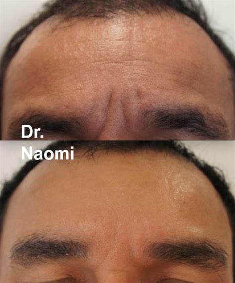 Forehead Filler Best Clinic Sydney For Dermal Fillers