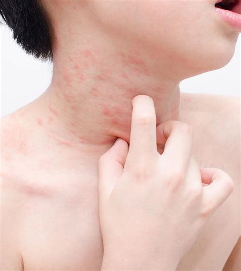 Real Life Experience Skin Rash On Childrens Body