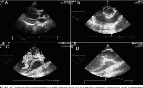 Figure 1 From Bacterial Endocarditis Involving Discrete Subaortic