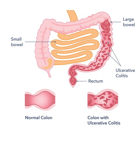 Ulcerative Colitis Causes Symptoms Treatment Support Guts UK